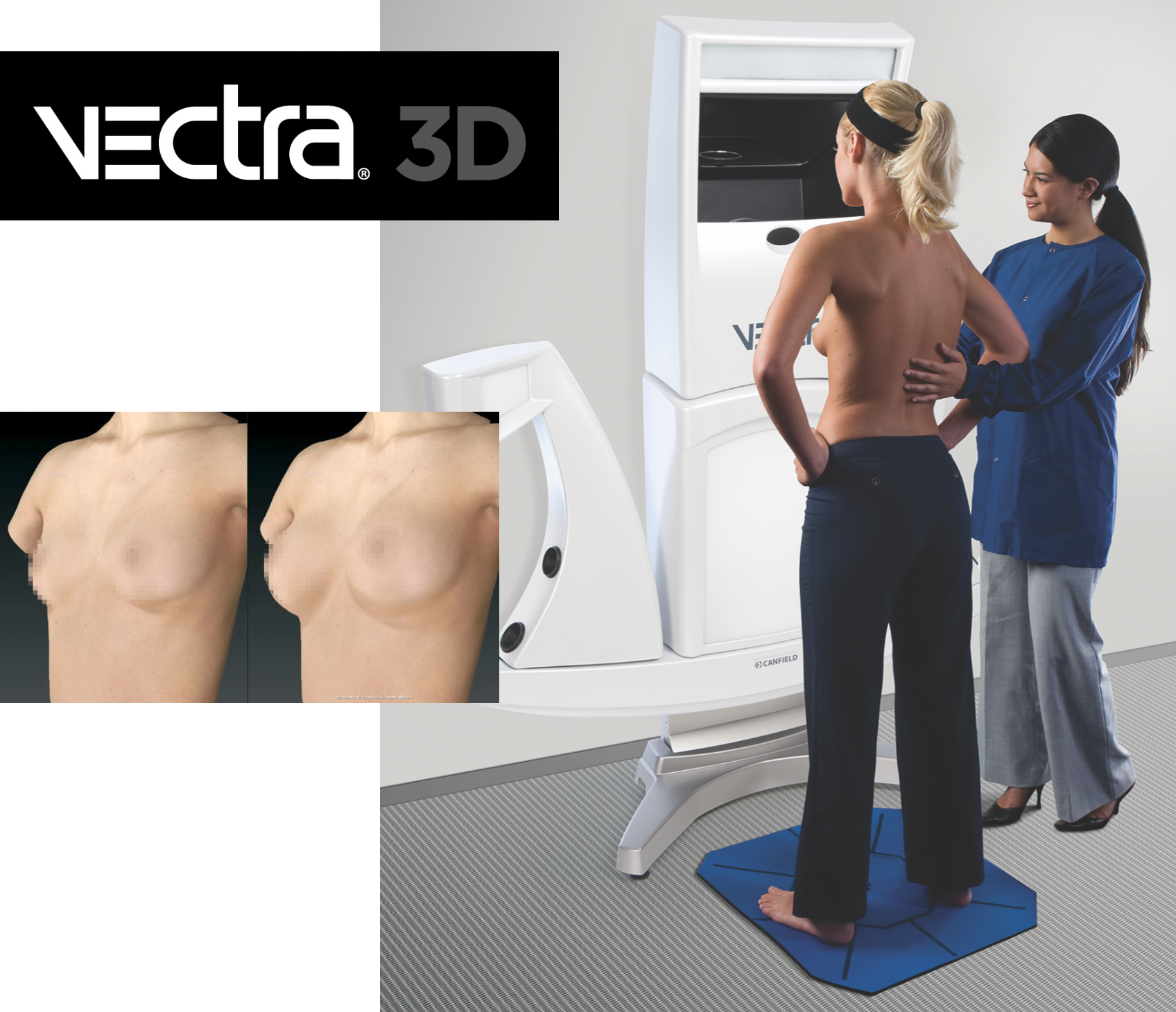 Vectra 3D breast augmentation preview
