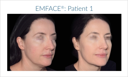 Emface chicago before and after treatment set 1