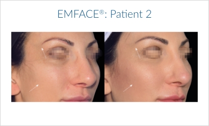Emface chicago before and after treatment set 2