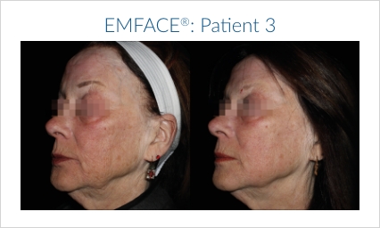 Emface chicago before and after treatment set 3