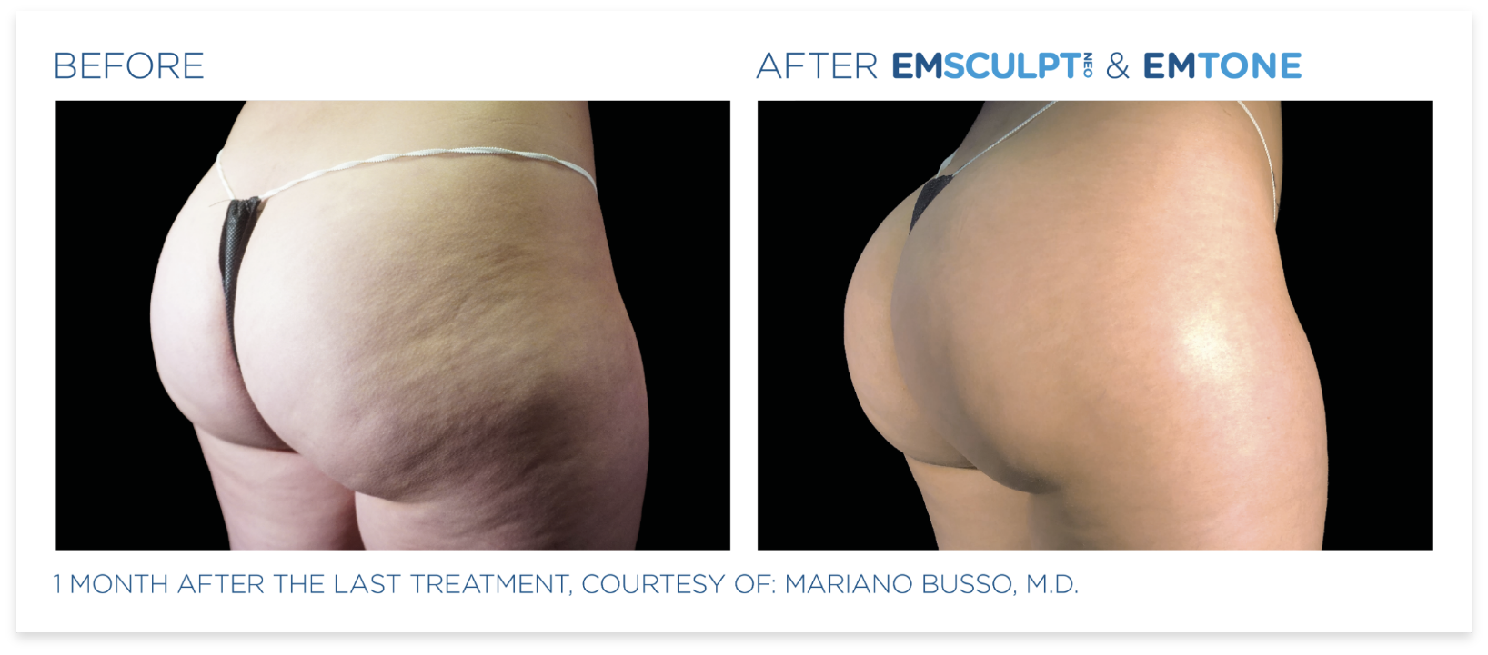 Emsculpt and Emtone Before and After