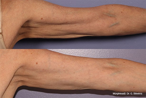 Chicago Morpheus8 before after arm treatment