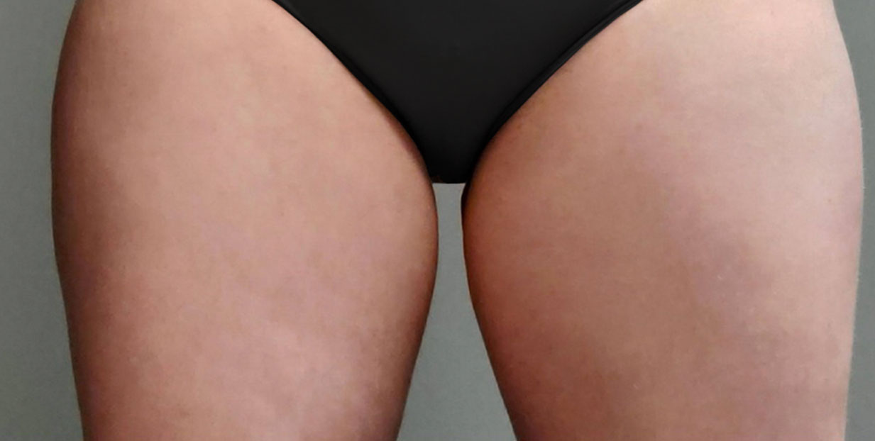 After Coolsculpting thigh