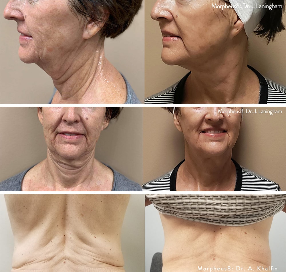 Chicago Morpheus8 microneedling before after skin tightening