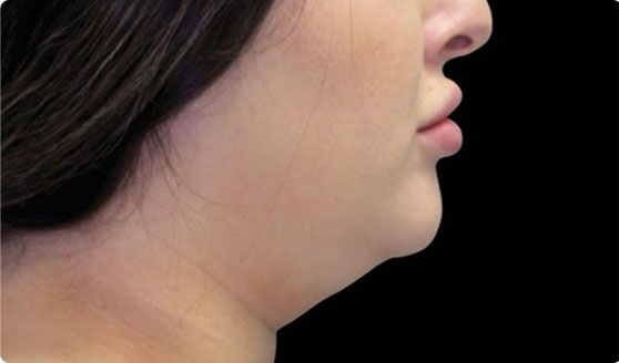 Before CoolSculpting chin